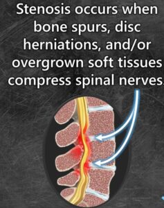Spinal Stenosis spinalstenosis v2