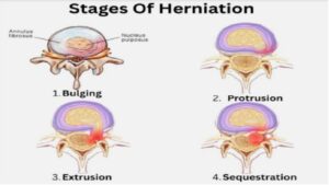stagesofdischerniation2